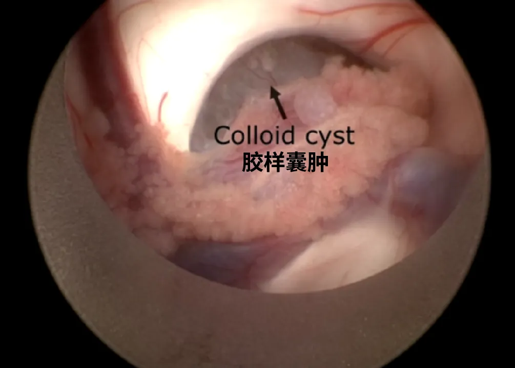 胶样囊肿