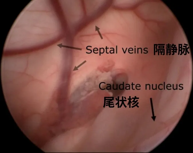 隔静脉和尾状核