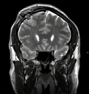 术后MRI 显示入路通道相对较靠外侧，未造成尾状核压迫性损伤。