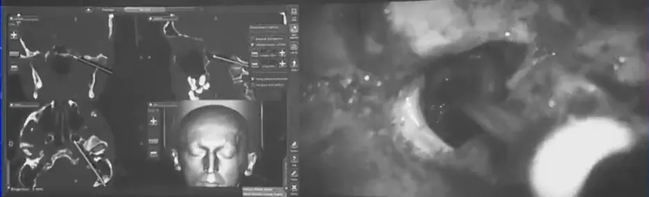 开颅手术终究难以触及海绵窦区域