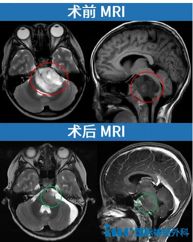 一日激增9mm！高级别胶质瘤患儿轮椅上逆袭：术后4月成运动健将