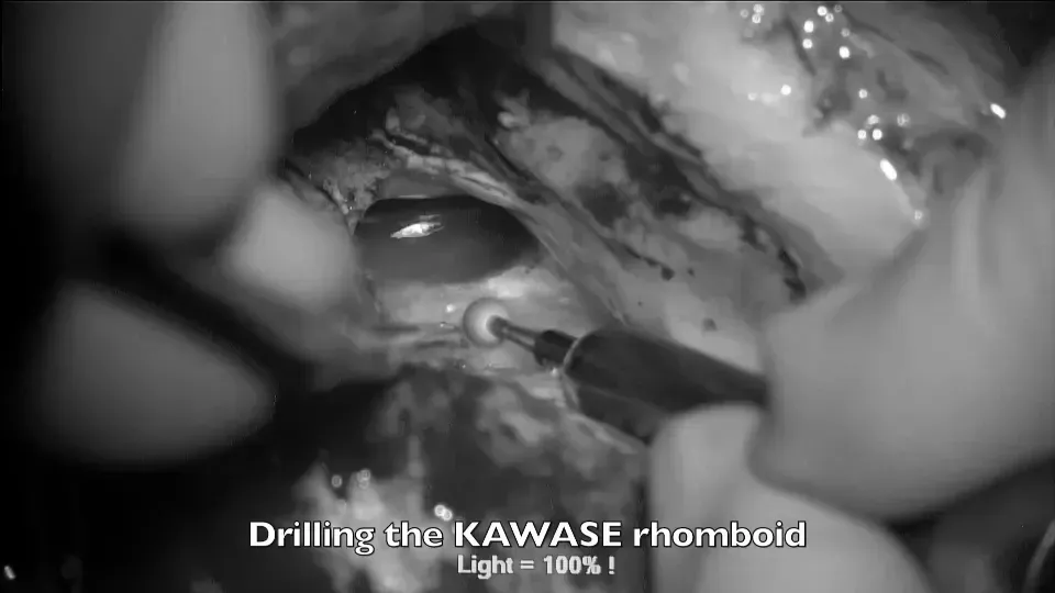 磨除KAWASE菱形区