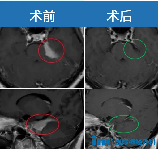 手术前后对比