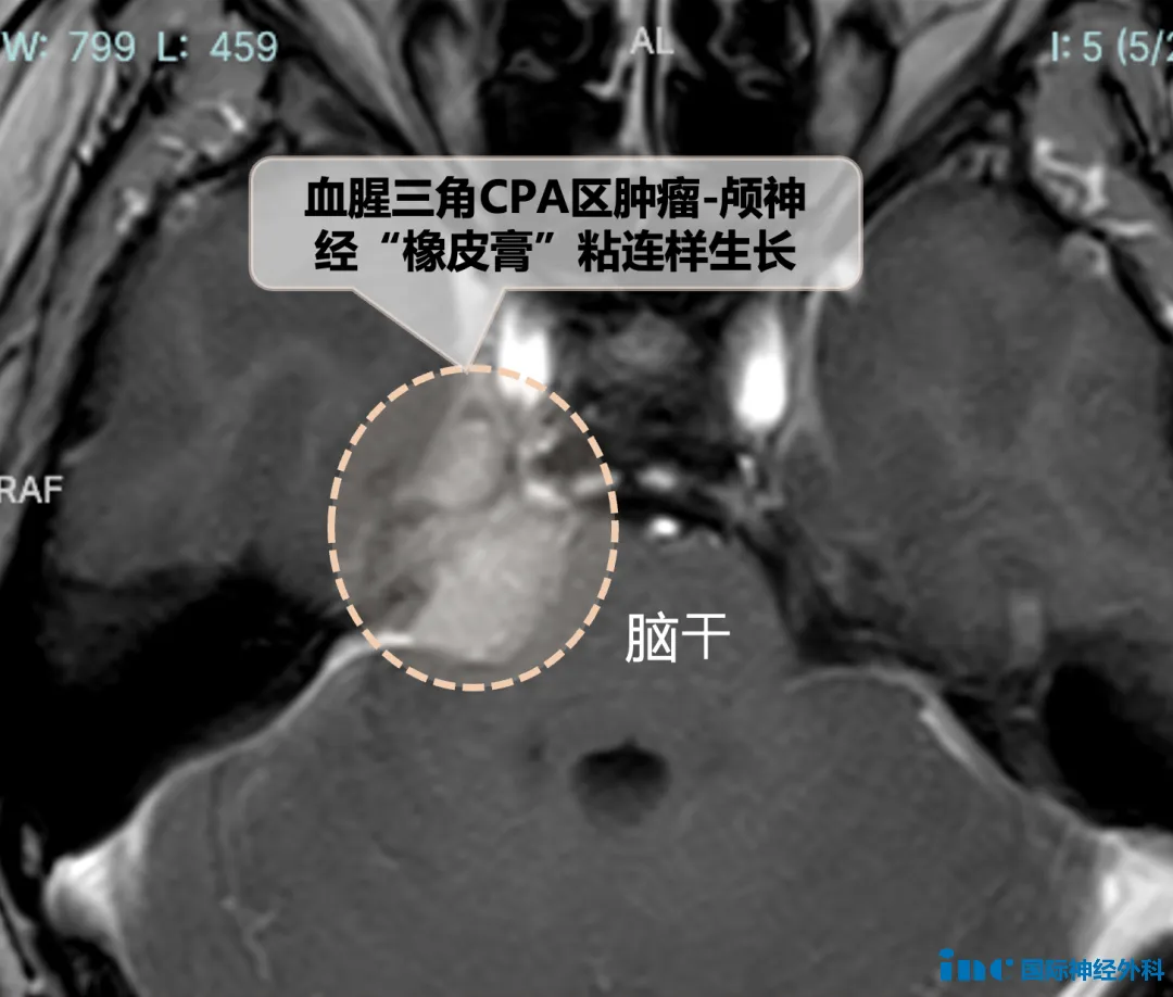 生命中枢的桥脑和中脑也受到压迫
