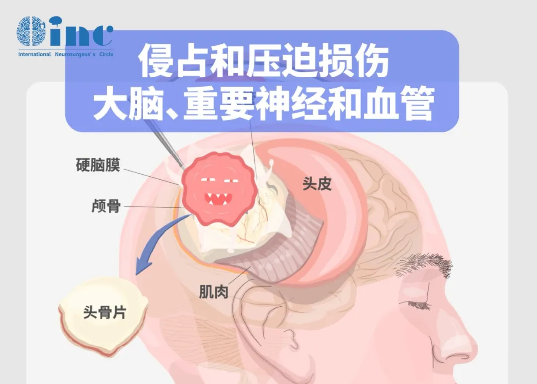 侵占和压迫损伤大脑、重要神经和血管
