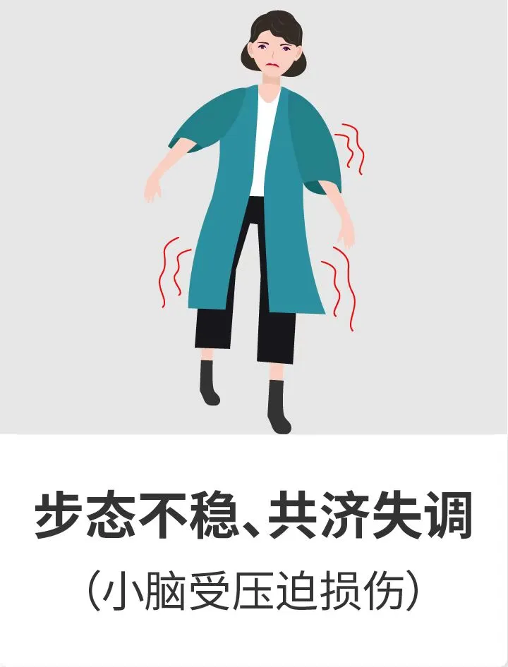 可能会出现记忆缺陷和步态障碍。浸润中脑的肿瘤可能导致运动和感觉功能障碍，以及伴有垂直凝视麻痹和眼球震颤的Parinaud综合征。