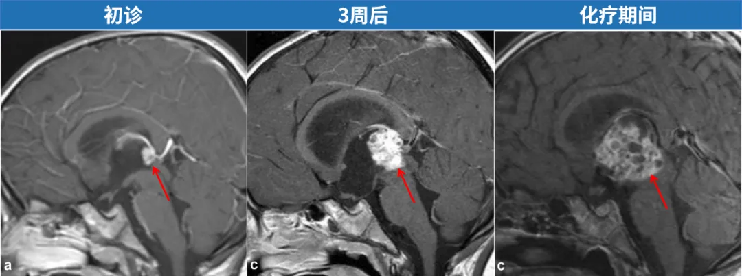 不断长大的<a href='/naoliu/' target='_blank'><u>脑瘤</u></a>：化疗、干细胞治疗均无效
