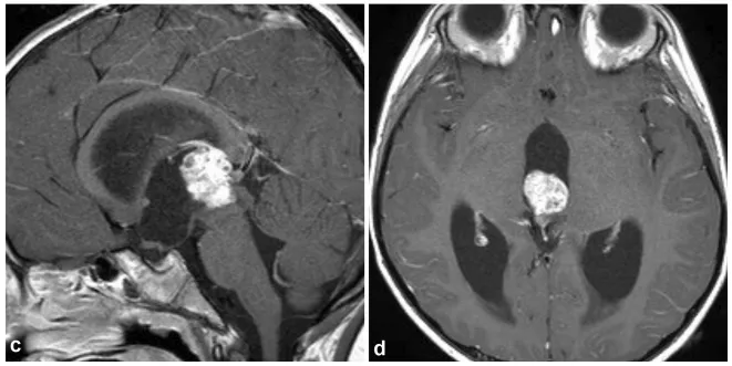 3周后的T1加权增强矢状位（c）和轴位（d）MRI