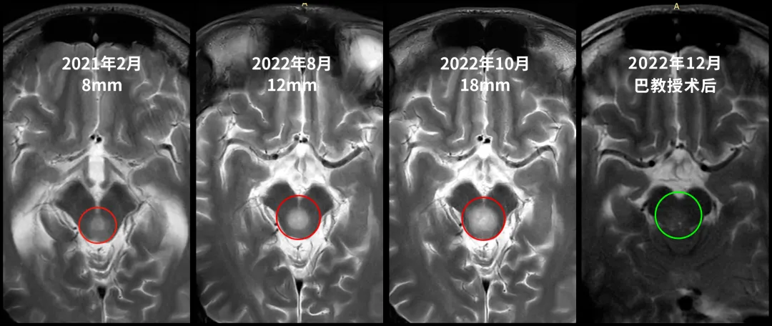 脑积水缓解≠肿瘤稳定