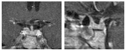 术后 1 年的术后 MRI 复查显示肿瘤完全切除以及正常的垂体腺。