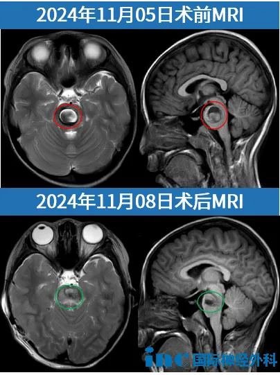 手术前后MRI对比