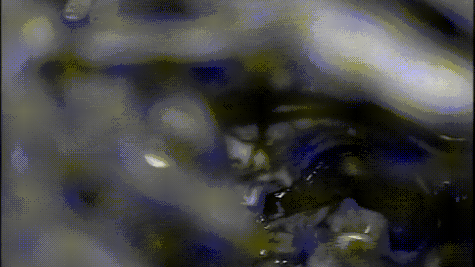 毛细胞星形细胞瘤可以很好地区分，因此可以找到边界，看到哪些是肿瘤，哪些不是肿瘤。