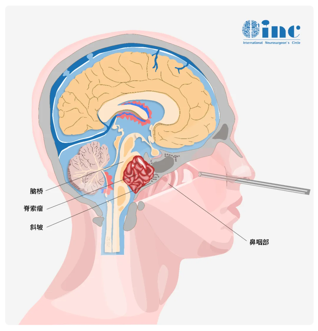 显微镜+神经内镜-“双镜联合”的手术