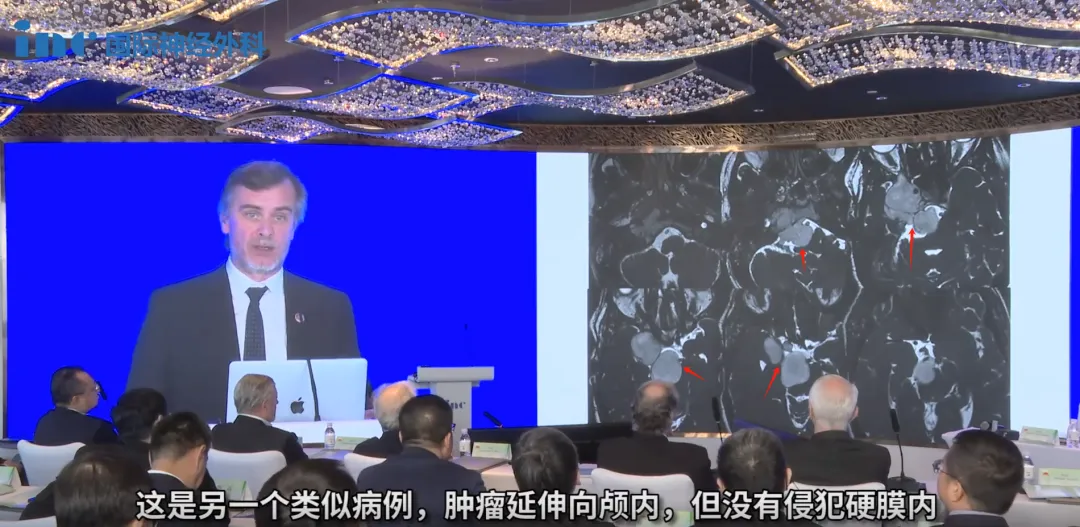 肿瘤尚未侵犯硬膜内，因此必须立即采取行动