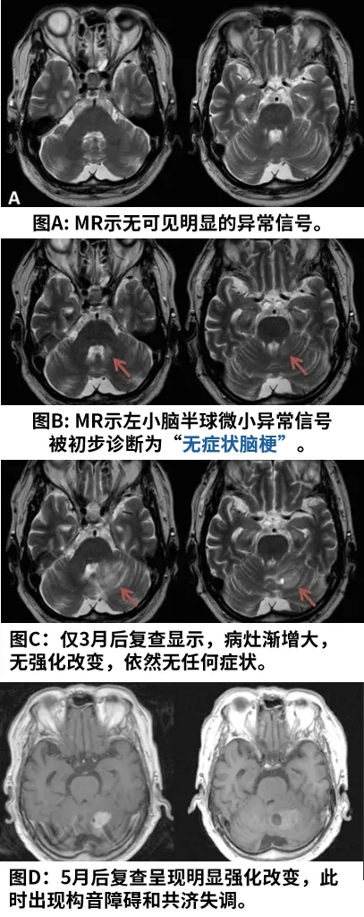 胶质瘤案例图片
