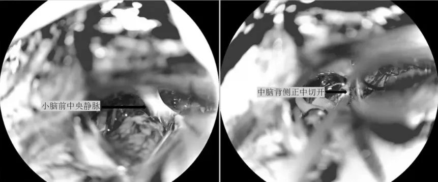 切除肿瘤上部及第三脑室上部肿瘤