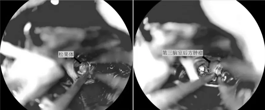 瘤腔止血