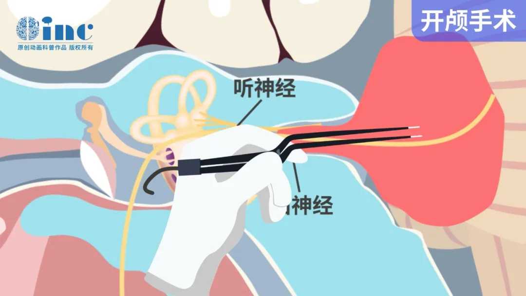术中“面神经烫伤”是怎么回事？