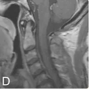 手术实现了全切除，术后 MRI 显示未见残留肿瘤或强化