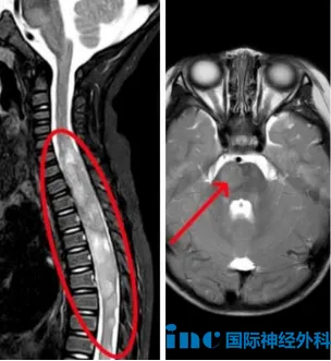 教授回复：在靶向治疗期间神经系统症状似乎在逐渐恶化，所以我认为要么换一种新的靶向药物，要么就该考虑手术。现在腿部不能动，部分原因是因为脊髓受到肿瘤的压力。必须通过手术缓解部分压力，脊髓功能才可能恢复。我们应当采取 “安全 + 有效”的手术策略，结合术后病理结果制定新的靶向治疗。我不建议等待太久，建议在接下来一到三个月内进行手术。我认为手术和靶向治疗联合使用，有可能带来恢复。