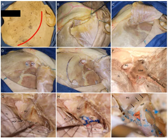 根据Fukushima和Froelich教授团队的实践经验，描述了前内侧三角（AMT）通道的扩展，以获得更宽的手术通道，并将其命名为“眶翼间隙”（OPC）