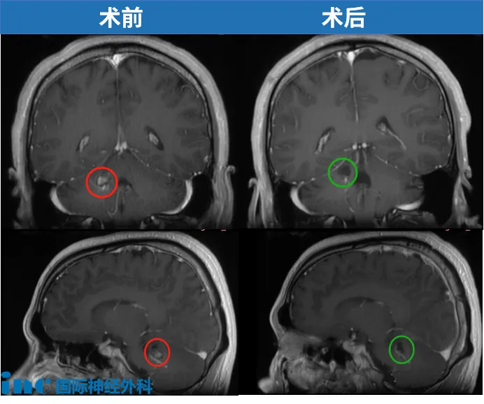 术前术后MRI对比