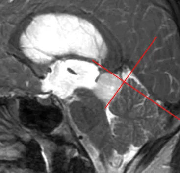 术前MRI