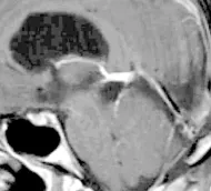 术后MRI