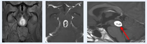 术前MRI