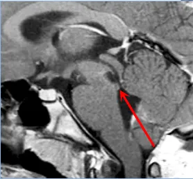 术后MRI
