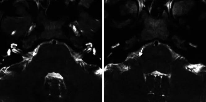 磁共振成像（MRI）采用稳态构建干扰序列未显示血管压迫