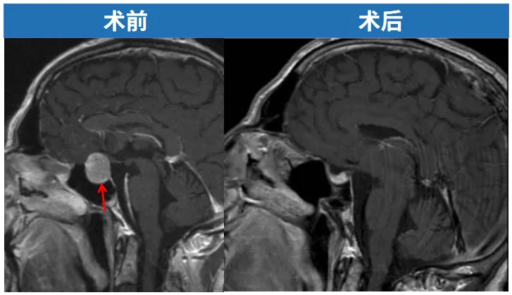 无需开颅、肿瘤被成功全切  恢复良好且无需激素替代治疗