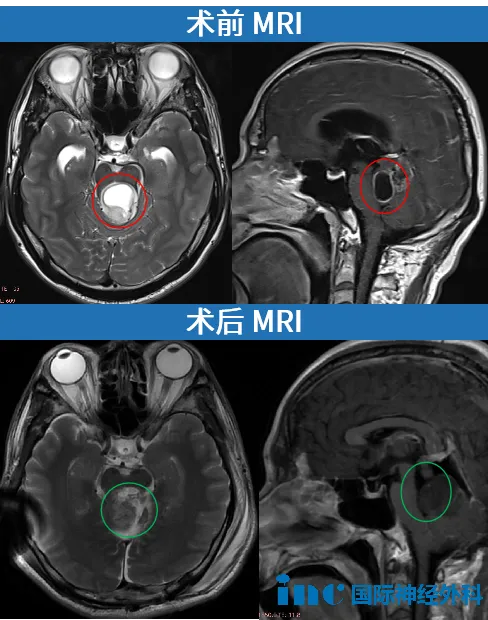 术后病理结果显示，该肿瘤为高级别胶质瘤，Ki67指数高达15%
