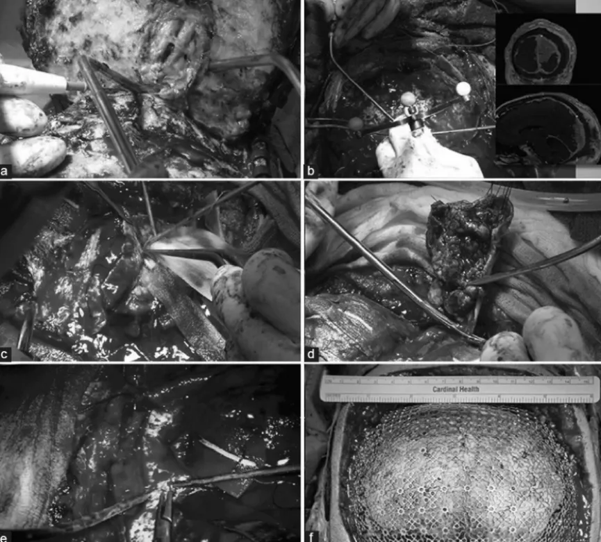 轴向（a）和冠状（b）对比增强的T1加权MRI证实肿瘤包裹着上矢状窦的后部。观察到后头皮异常增厚。（c）轴向T2加权MRI序列显示枕叶白质异常高强度，与实质性肿瘤浸润引起的血管性水肿一致。（d）增强CT扫描，显示枕骨由于肿瘤浸润而变厚的骨质肥大。