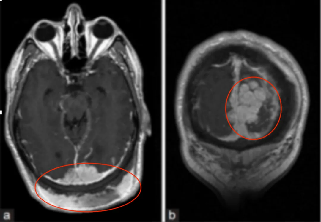 大脑的磁共振成像和磁共振血管造影(MRI/MRA)，结果显示一个11×5cm的肿块，向上和下延伸至双侧顶叶和枕叶、上矢状窦、小脑环和近端横窦。