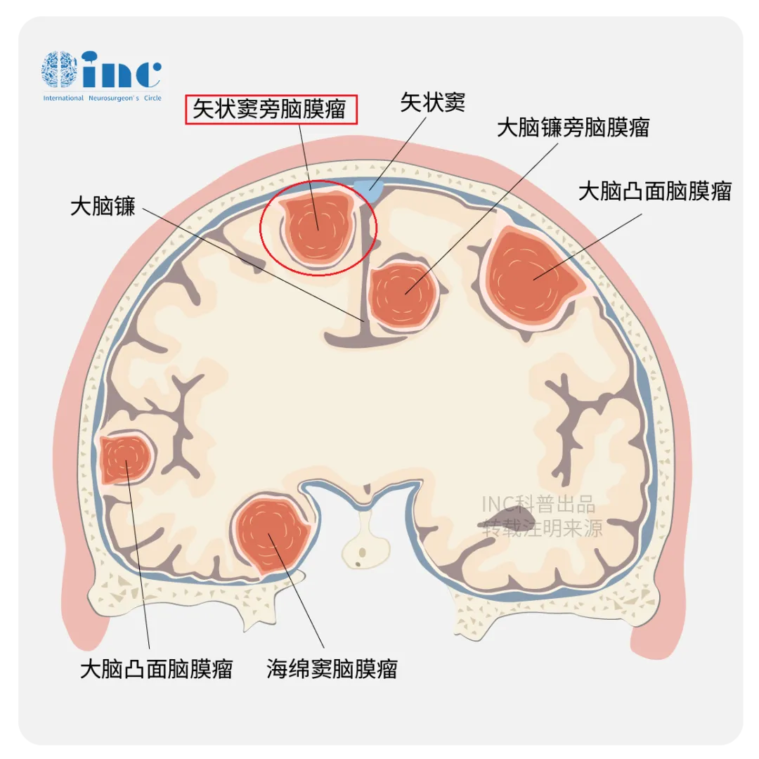 矢状窦旁脑膜瘤是最常见的脑膜瘤，常发生于蛛网膜颗粒密集的地方，这些肿瘤15%侵犯硬脑膜窦。