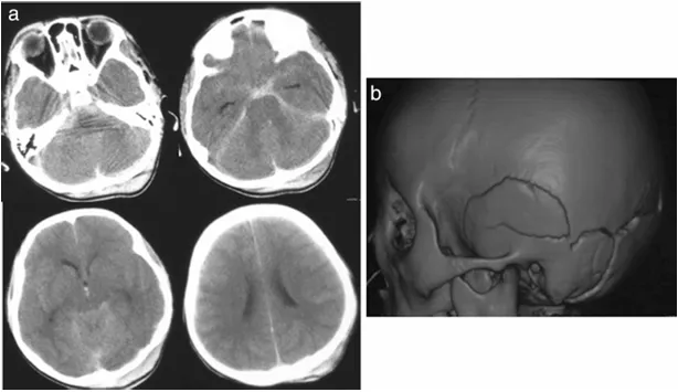 头部 CT 显示弥漫性蛛网膜下腔出血和心室扩张。3D-CT 显示多发性颅骨骨折。