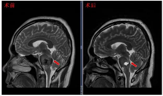 术后MRI显示面丘结构恢复