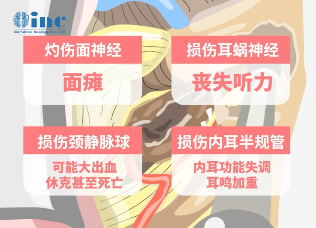 听神经瘤手术切除后遗症