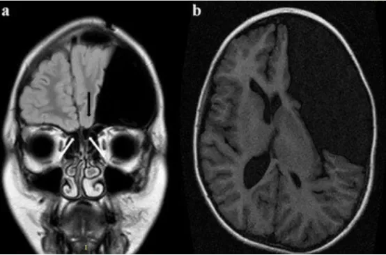 示例病例的术前 MRI（冠状面）显示嗅球缺失（白箭头），左侧嗅沟发育不全（黑箭头）。左侧眶回和右侧回分化不良，部分被蛛网膜囊肿压迫；b 注意左侧较大的外侧裂蛛网膜囊肿（术前 MRI 轴面）。