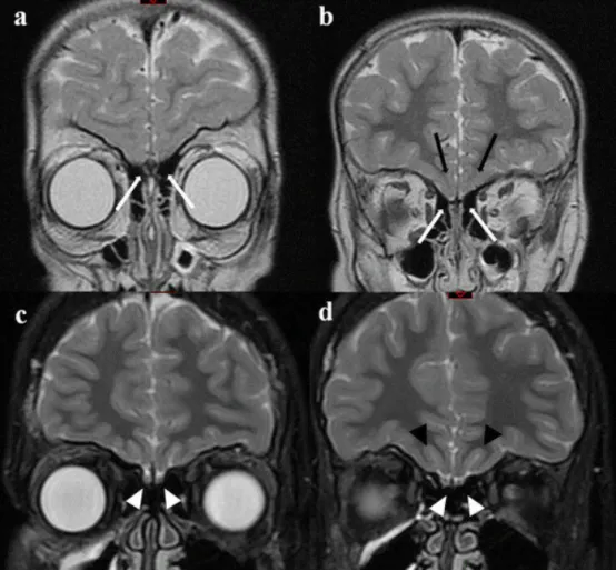 8 岁 KS 女童的 MRI 冠状面视图。嗅球缺失（a，白箭头），嗅束亦缺失（b，白箭头）。嗅沟双侧缺失，右侧眶回与眶沟界限不清（b，黑箭头）；10 岁健康男童的 MRI 冠状面视图。可见正常的嗅球（c，白箭头）和嗅束（d，白箭头），眶沟双侧正常（d，黑箭头），右侧眶回与眶沟界限清晰。