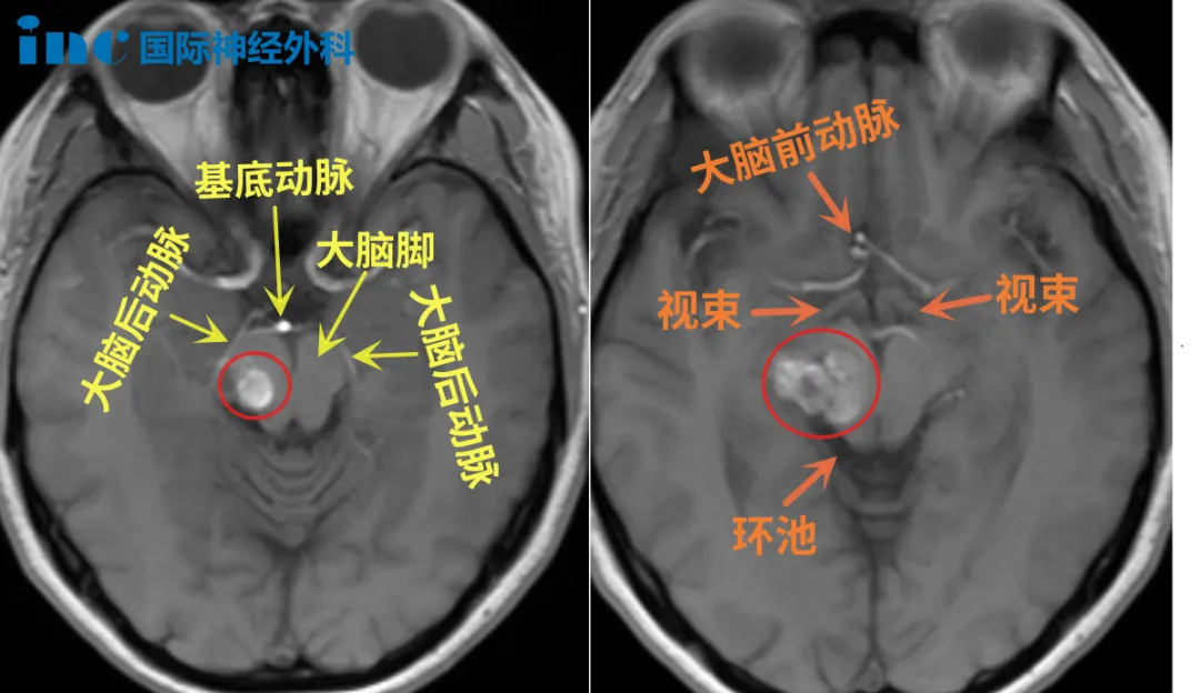 不同于第1次丘脑出血，这次是脑干附近的再次出血：手麻、心悸、早搏