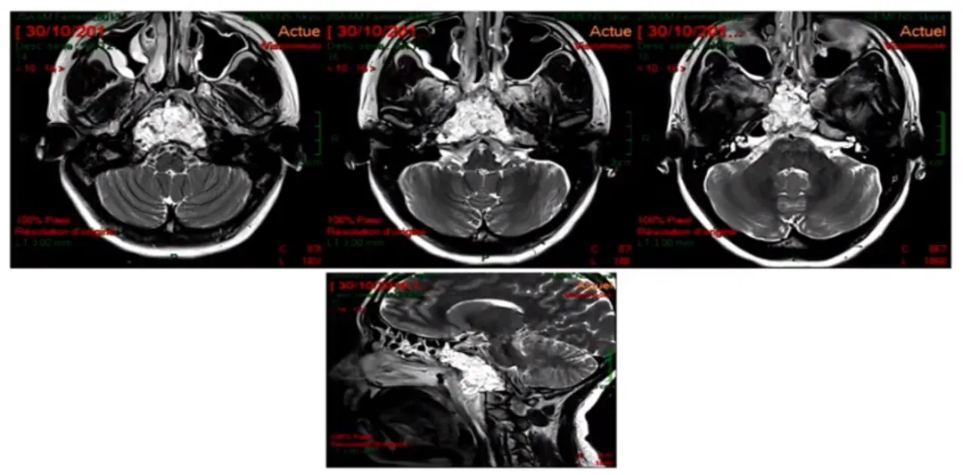 这是术后的MRI，高信号的是脂肪组织