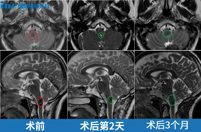 术前术后MRI对比