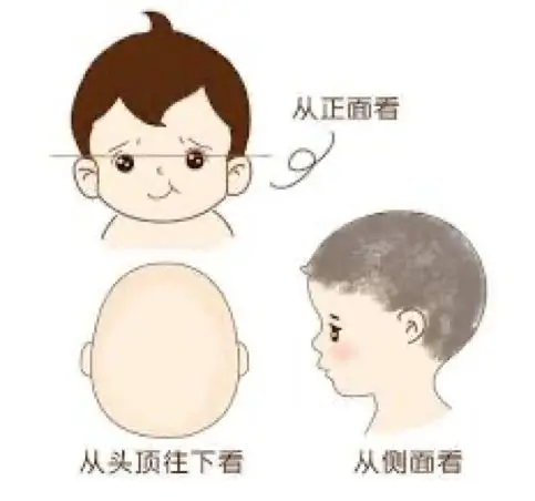 诊断  矢状缝早闭大都可通过视诊或触诊发现