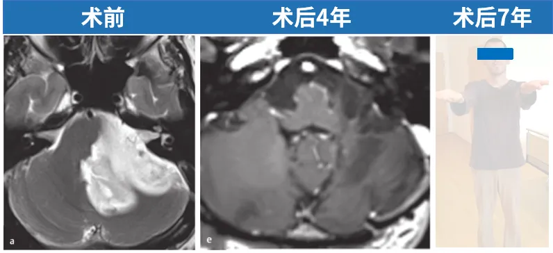INC巴教授强调：对脑干胶质瘤不应一概而论地贴上 “不可手术” 标签。在许多情况下，显微外科肿瘤切除是可行的，但必须严格筛选患者。尤其对于低级别患者，尤其是毛细胞星形细胞瘤患者，我们甚至可以治愈他们，治愈意味着至少25年无肿瘤进展，而我已经治愈了其中的一些患者。
