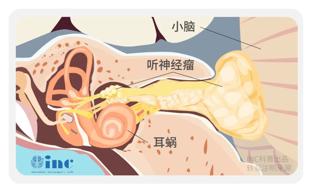 听神经瘤长在哪里？