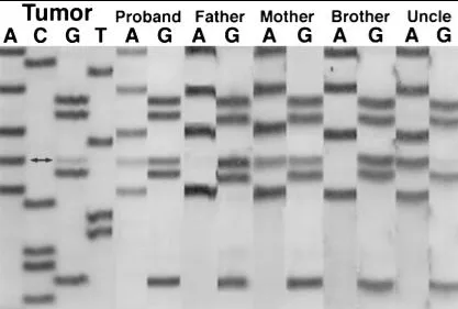 图 3 为对先证者肿瘤、先证者种系以及母亲种系 DNA 的 hSNF5 第 7 外显子进行测序，显示在先证者肿瘤、先证者种系及母亲种系 DNA 中存在 G→A 突变（双箭头），而先证者父亲和兄弟的白细胞 DNA 显示野生型序列。先证者肿瘤和其叔叔的肿瘤（Uncle）显示出相同的 G→A 突变。