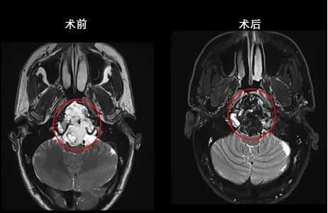 在福教授团队的精密操作下，安德鲁先生的脊索瘤被成功全切。术中未发生脑脊液漏，未伤及颅神经或重要血管，整个手术过程安全可控，术野清晰，出血量极小。