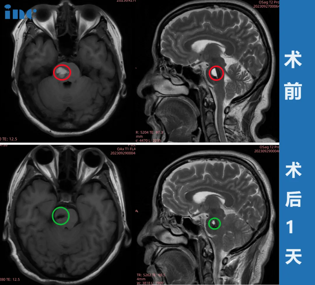 金女士术后1天影像对比